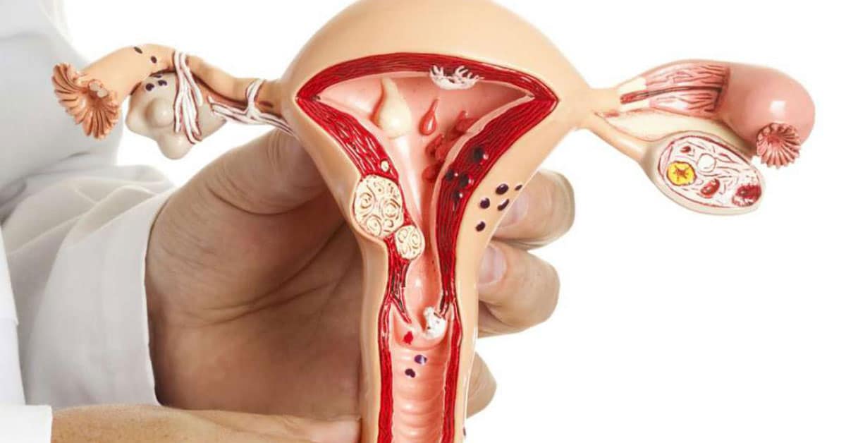 polipi-endometriali