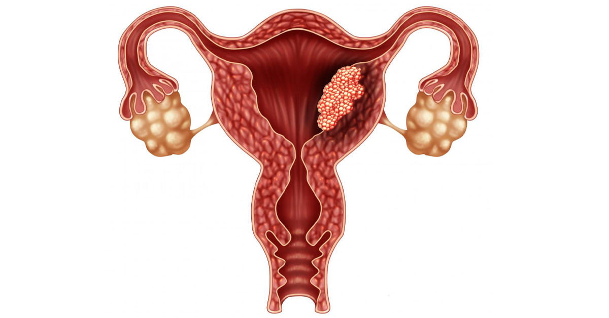 cancer-endometrial