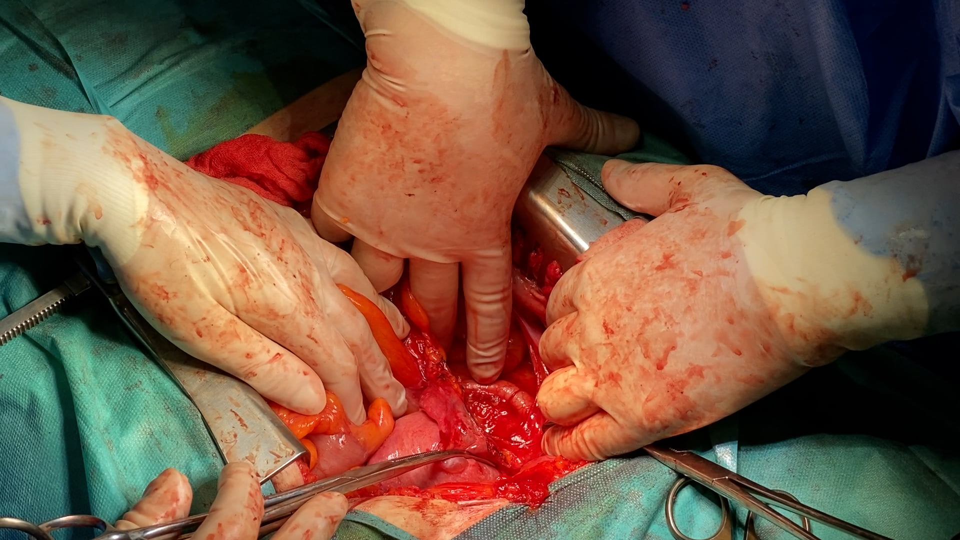 Cancer endometrial02