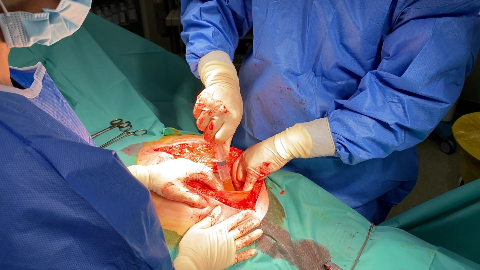 Tumora-abdominala-giganta-suspecta-de-cancer-ovarian-3