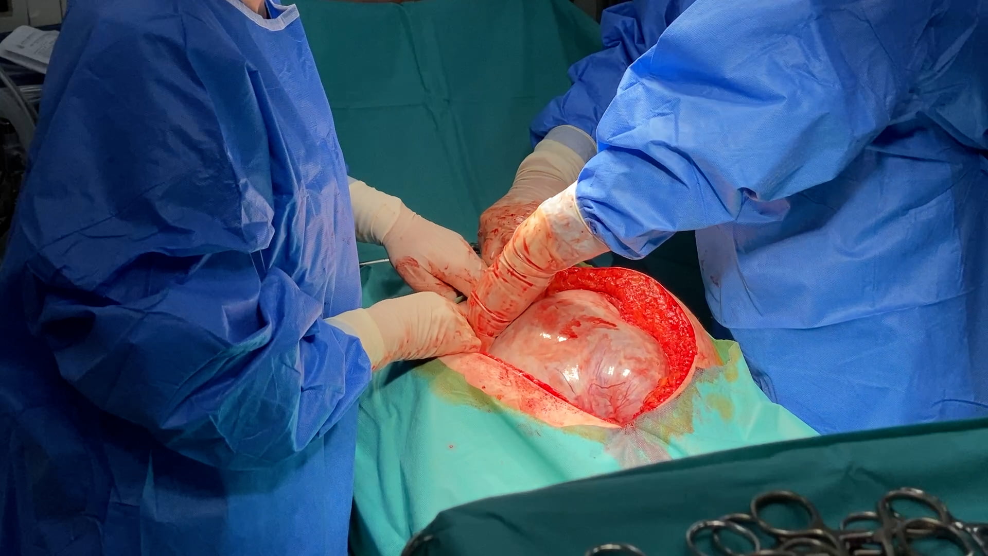 Tumora-abdominala-giganta-suspecta-de-cancer-ovarian-6