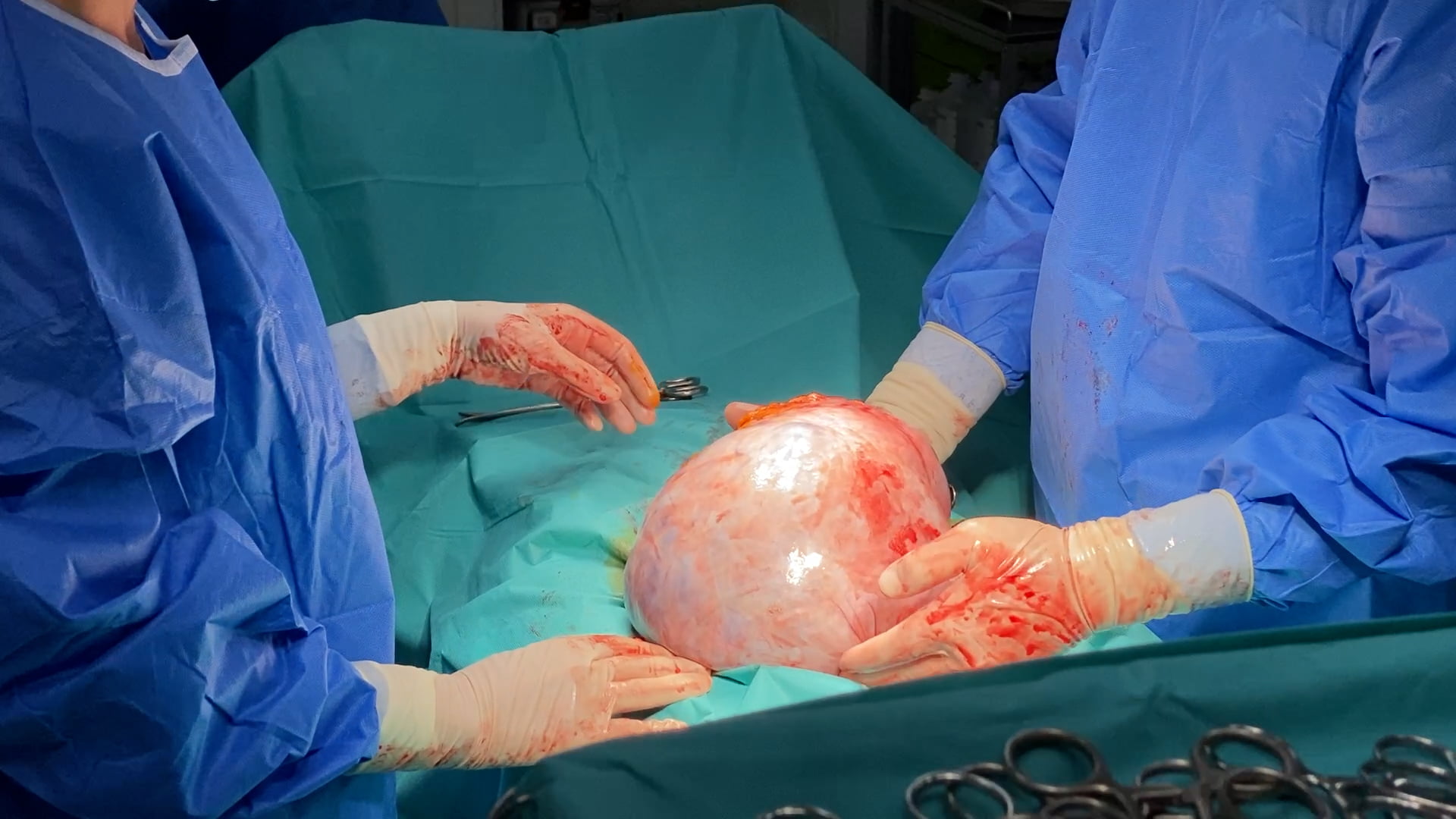 Tumora-abdominala-giganta-suspecta-de-cancer-ovarian-7