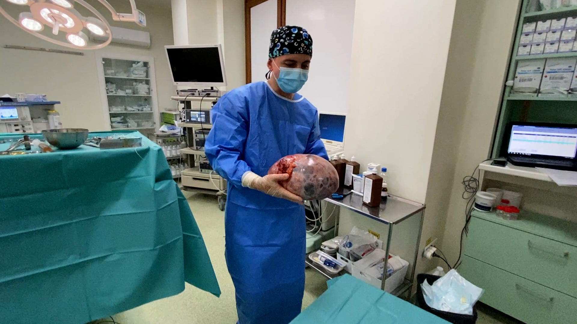 Tumora-abdominala-giganta-suspecta-de-cancer-ovarian-9