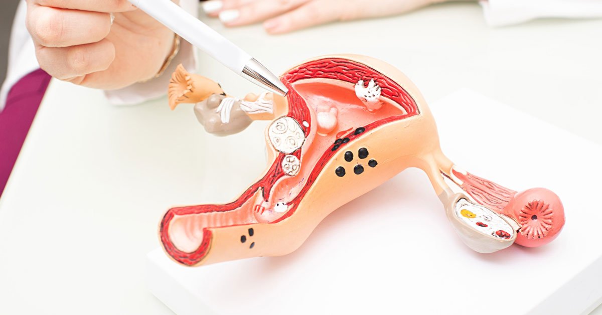 cancerul-ovarian cancerul ovarian