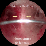 sept-uterin-5