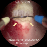 sept-uterin-6