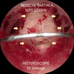 sept-uterin-7