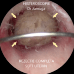 sept-uterin-8