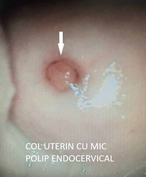Col uterin