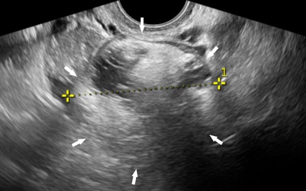 Chist-ovarian-dermoid