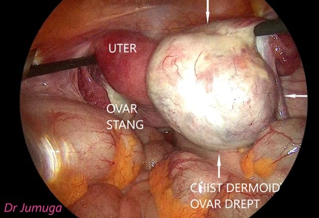 Chist-ovarian-dermoid laparo 1