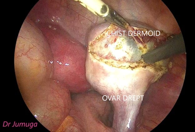 Chist-ovarian-dermoid laparo 2