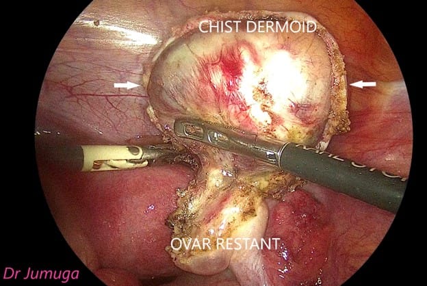 Chist-ovarian-dermoid laparo 3