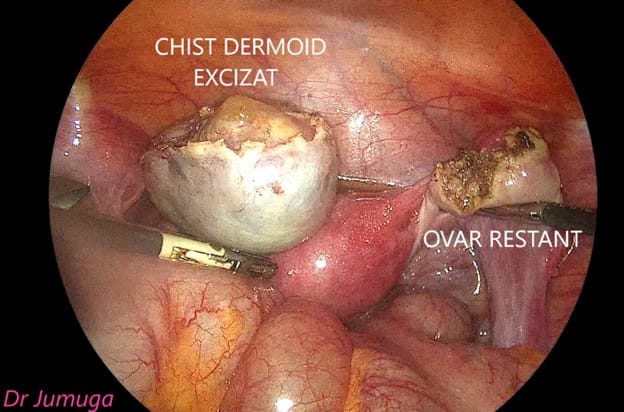 Chist-ovarian-dermoid laparo 4