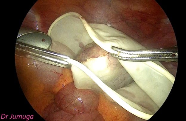 Chist-ovarian-dermoid laparo 5