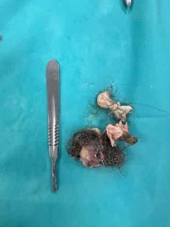 Chist-ovarian-dermoid laparo 6