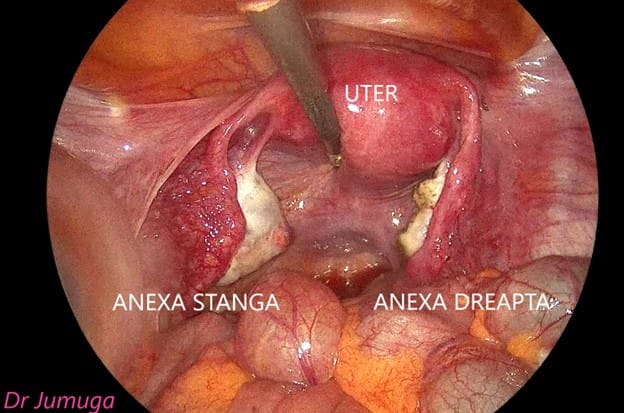 Chist-ovarian-dermoid laparo 7