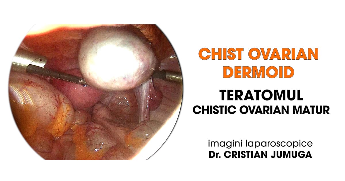 Chist-ovarian-dermoid