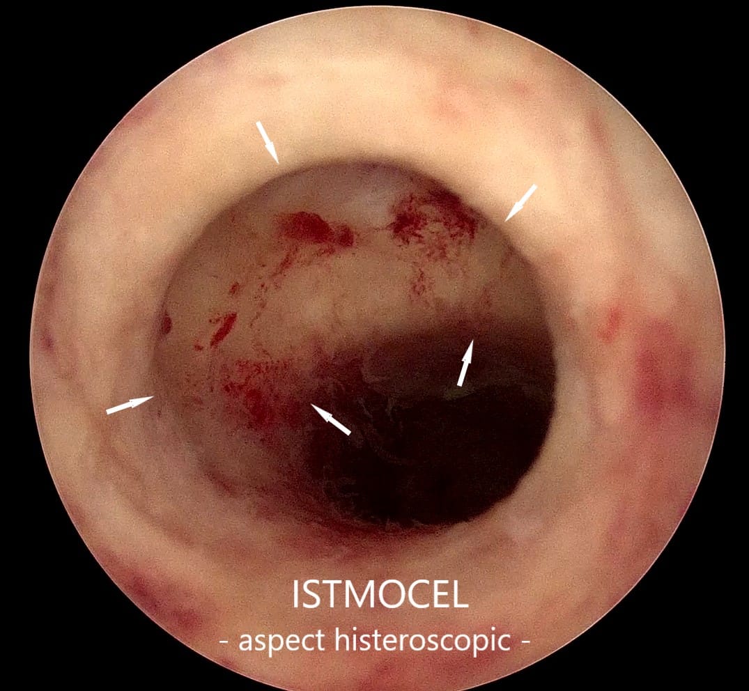 istmocelul istmocelul