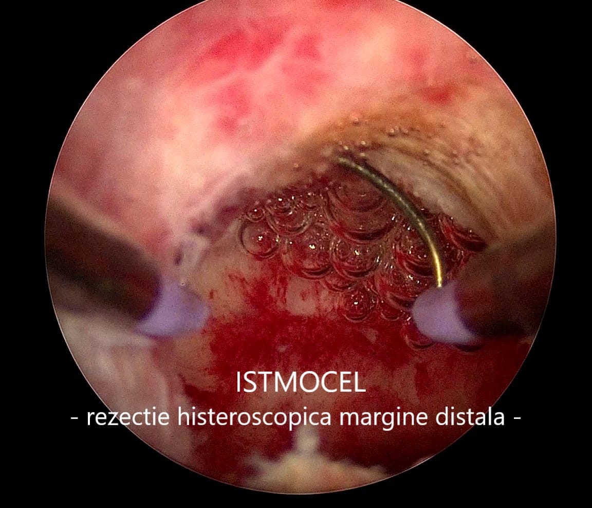 istmocel6 istmocelul